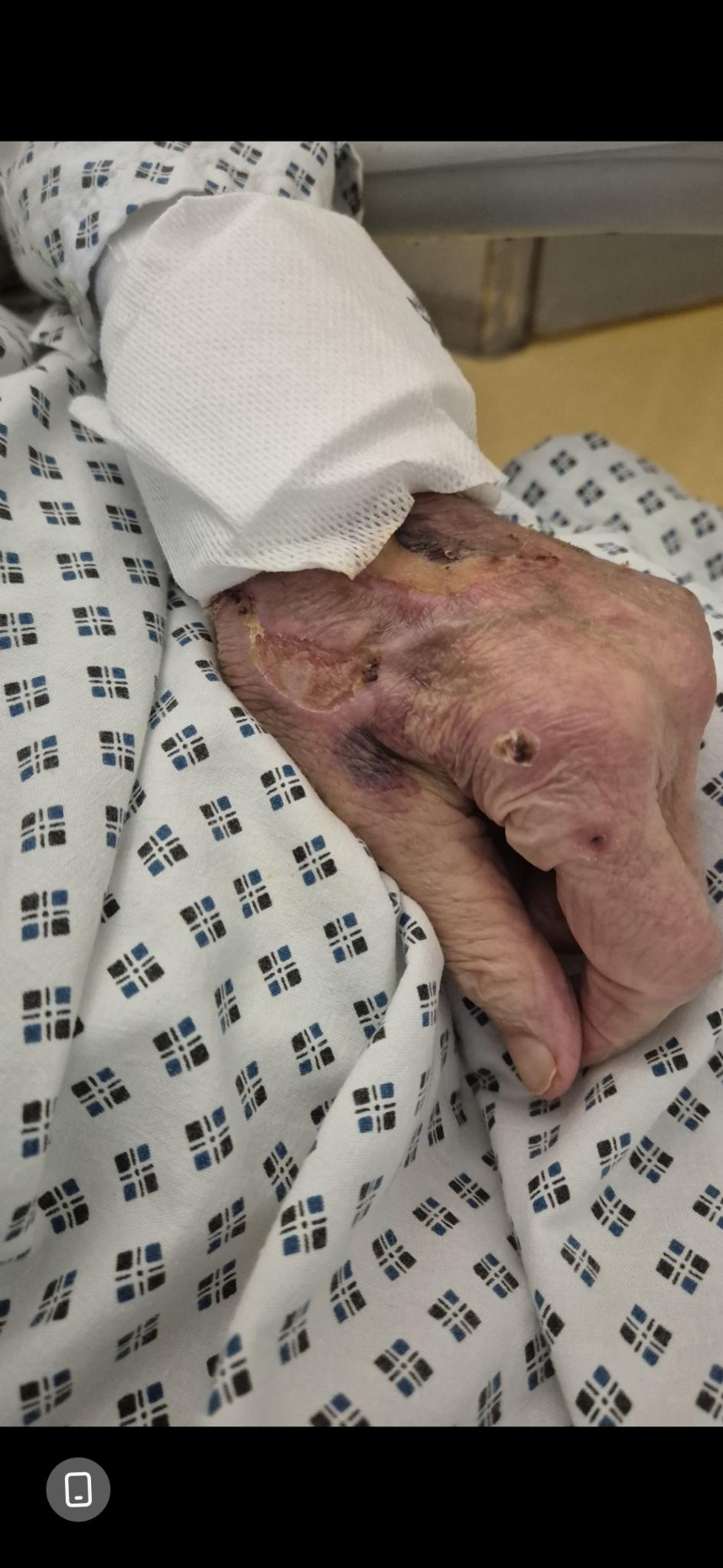 Bras ravagés par Pseudomonas